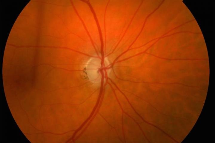 Potential predictor of glaucoma damage identified, treatment for glaucoma, glaucoma prevention, is glaucoma hereditary, glaucoma cure, what causes glaucoma, how long does it take to go blind from glaucoma, glaucoma signs and symptoms, glaucoma and diabetes,