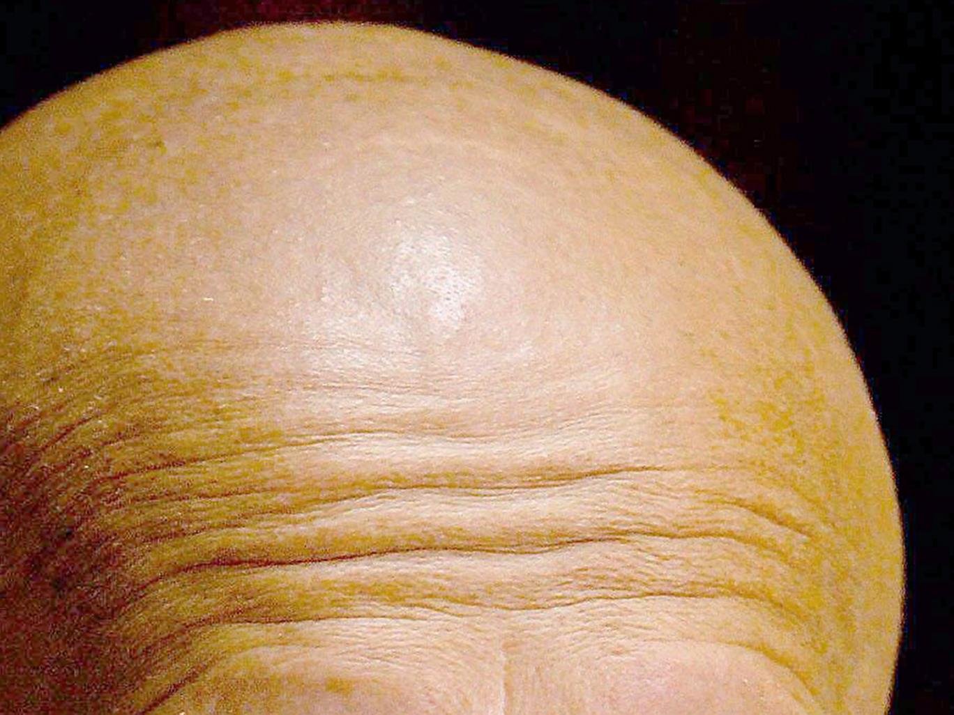 New baldness cause accidentally discovered by scientists could lead to hair loss treatment