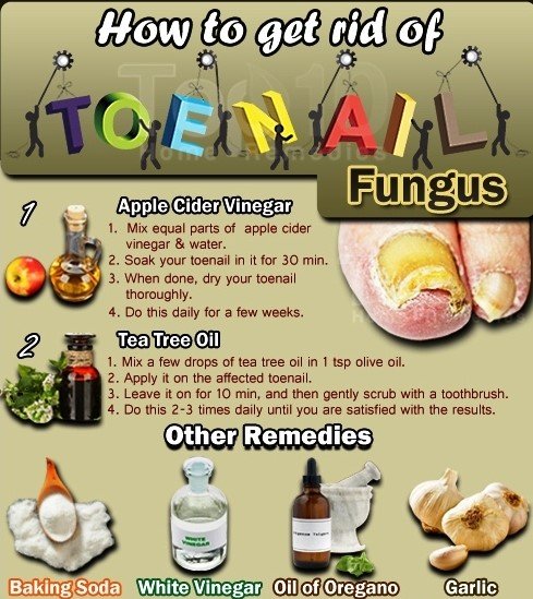 How to Get Rid of Toenail Fungus Fast and Effectively