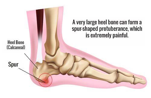 What is Heel Spur?