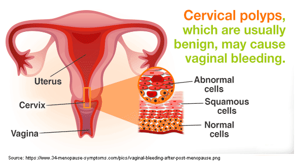 Uterine polyps