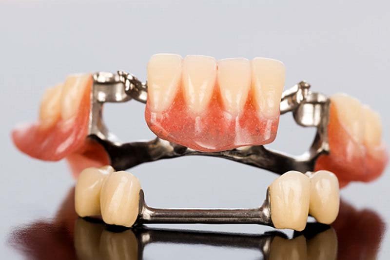 Difference Between Complete and Partial Dentures - Women Fitness Magazine