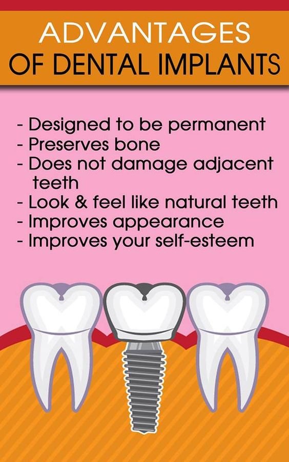 advantages of dental implants 2