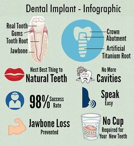dental implants infographic