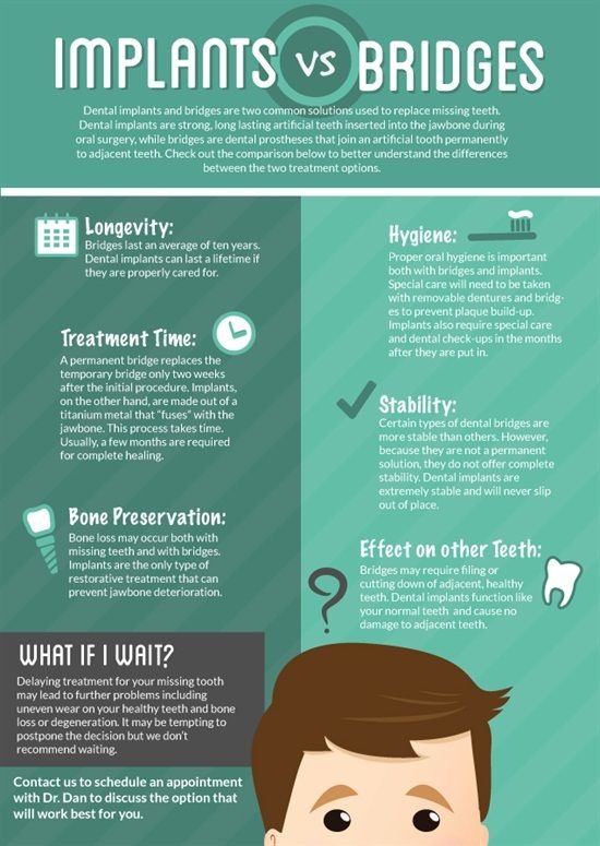 dental implants vs bridges