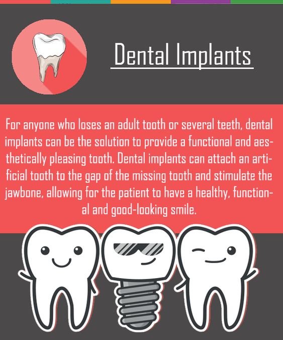 dental implants