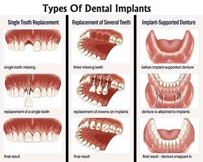 types of dental implants