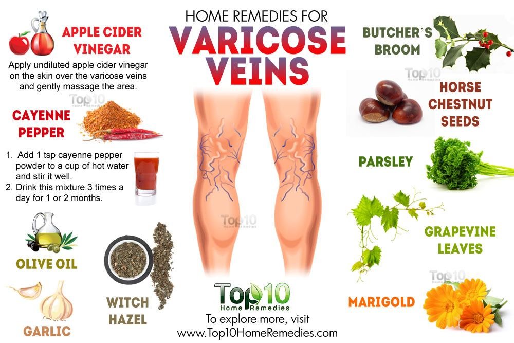 Home remedies for Varicose Veins