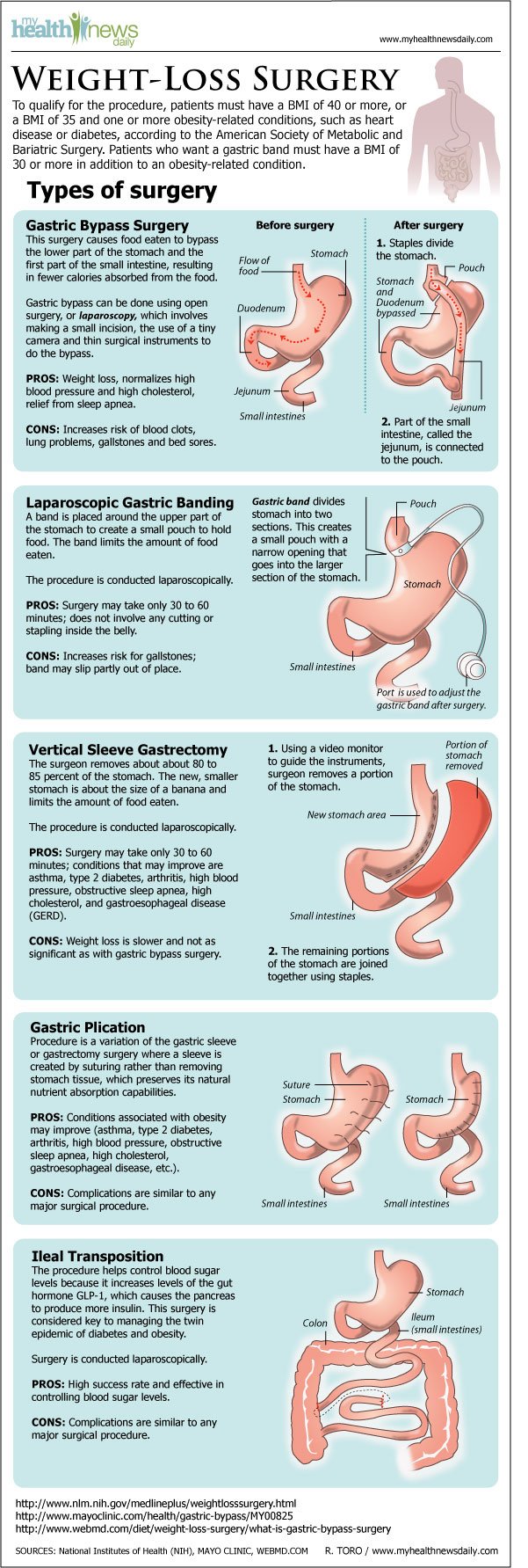 Types of Weight loss surgery