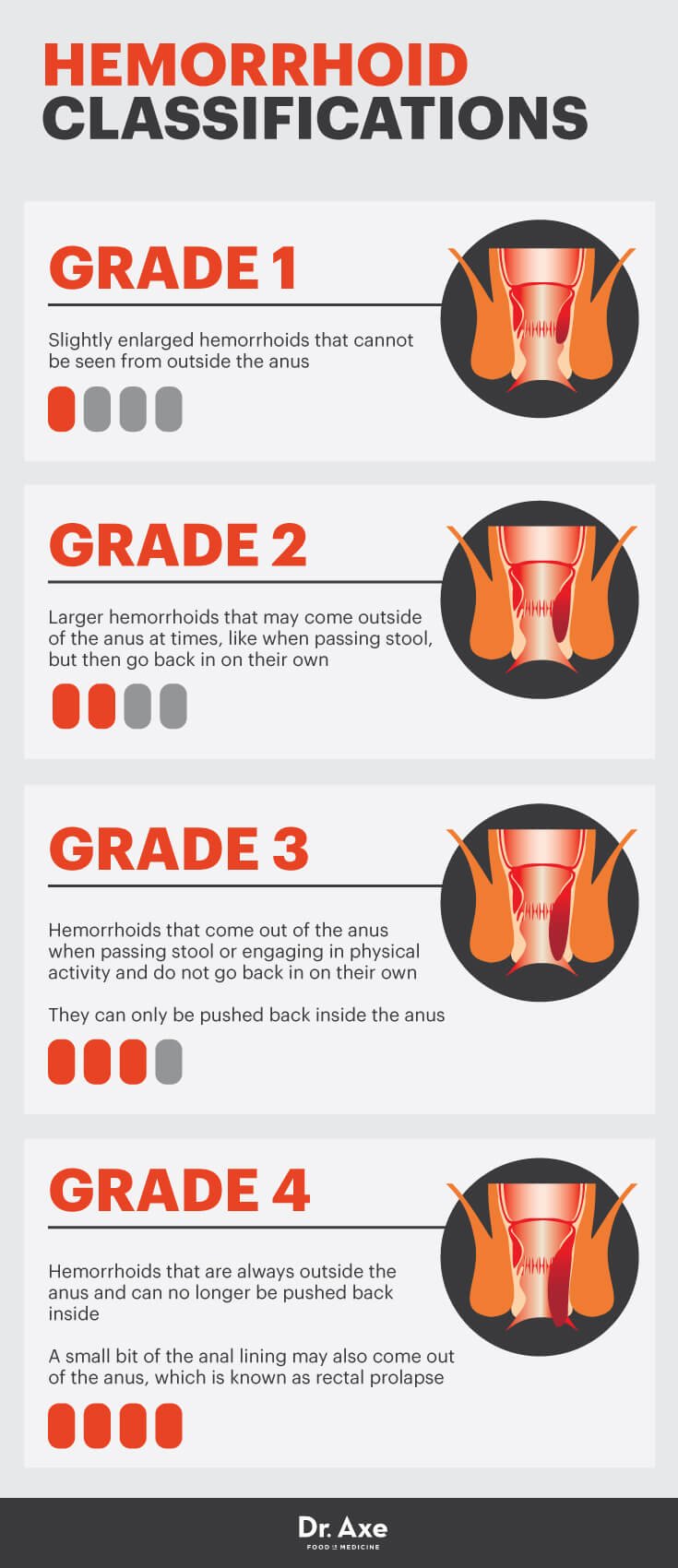 Hemorrhoid Stages