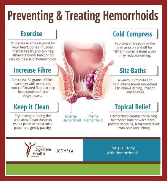 Preventing and Treating hemorrhoids