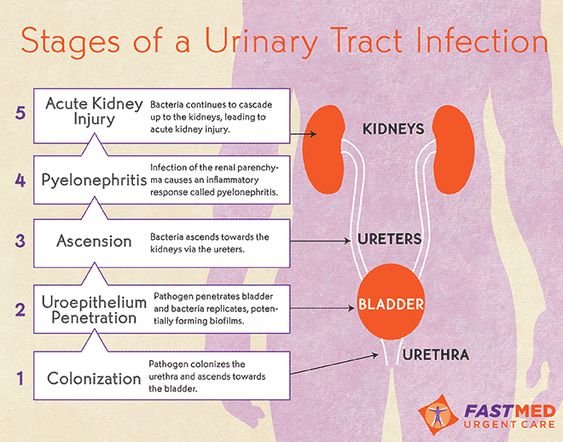 Stages of a Urinary Tract Infection