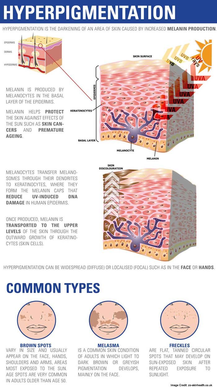 types of hyperpigmentation