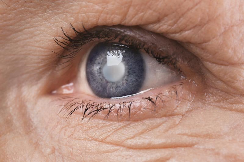 5 Questions That A Patient Should Ask Before A Cataract Surgery