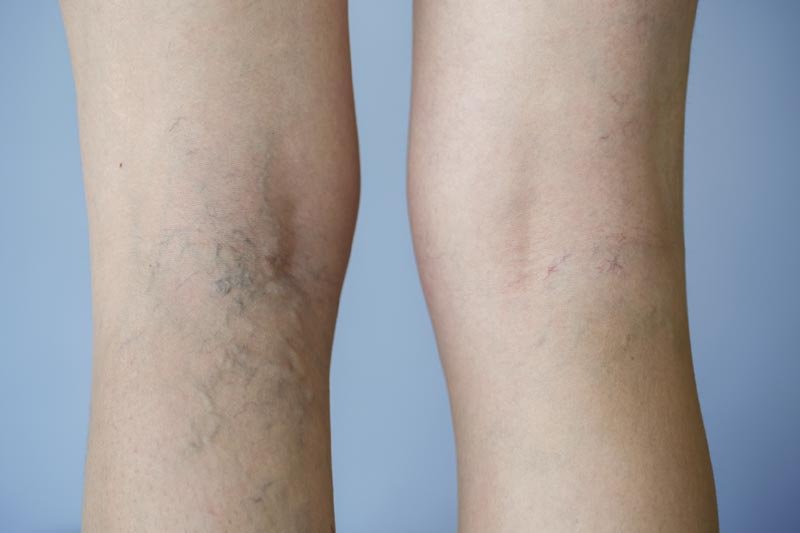 Vein Doc Ali Meslemani - Understanding Options for Varicose Vein Treatment