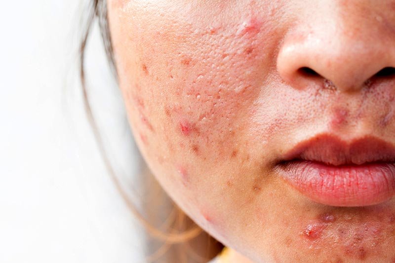 4 Natural Remedies for Acne That Will Clean Your Skin
