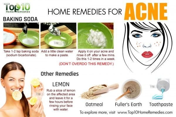 Home Remedies for Acne