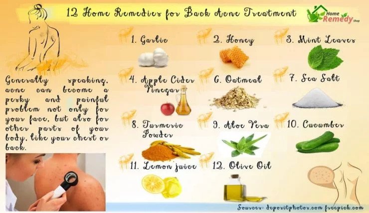 Home Remedies for Acne Treatment