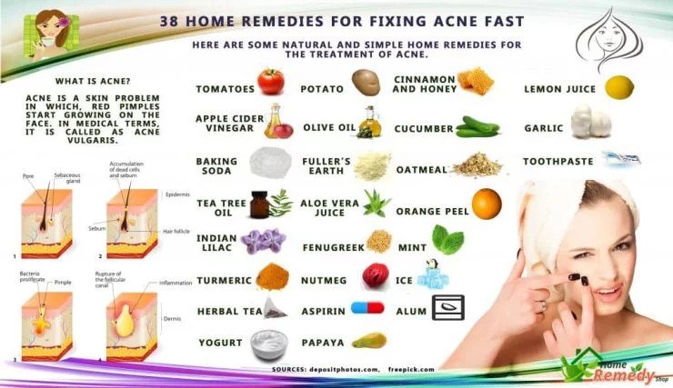 Home Remedies to fix Acne naturally