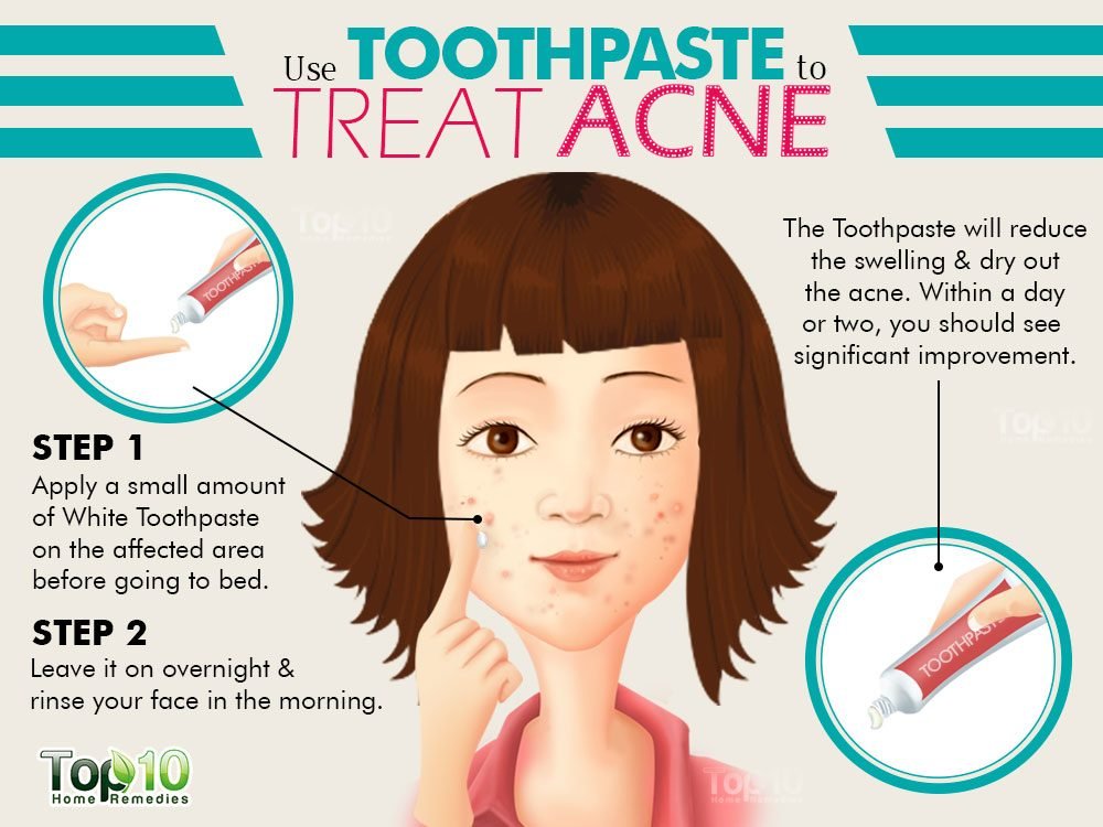 How to use Toothpaste to treat Acne