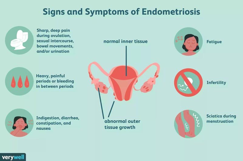 Signs and Symptoms of Endometriosis