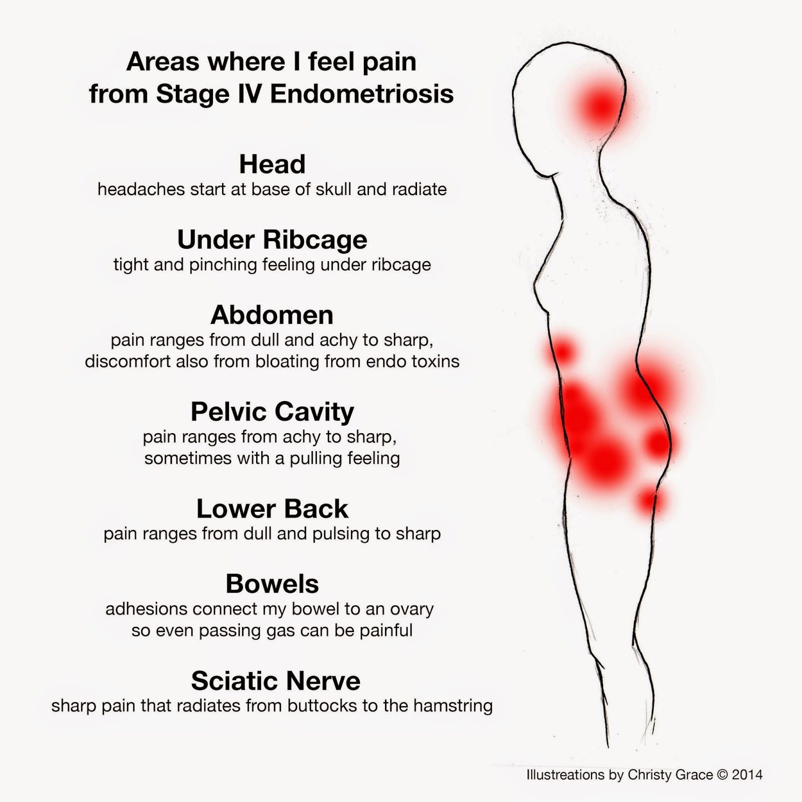 areas where pain is felt from stage 4 Endometriosis