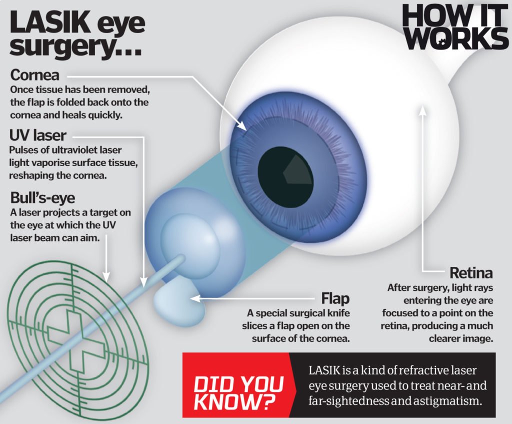 LASIK eye Surgery