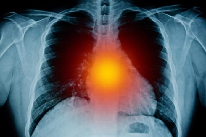 mesothelioma treatment guidelines