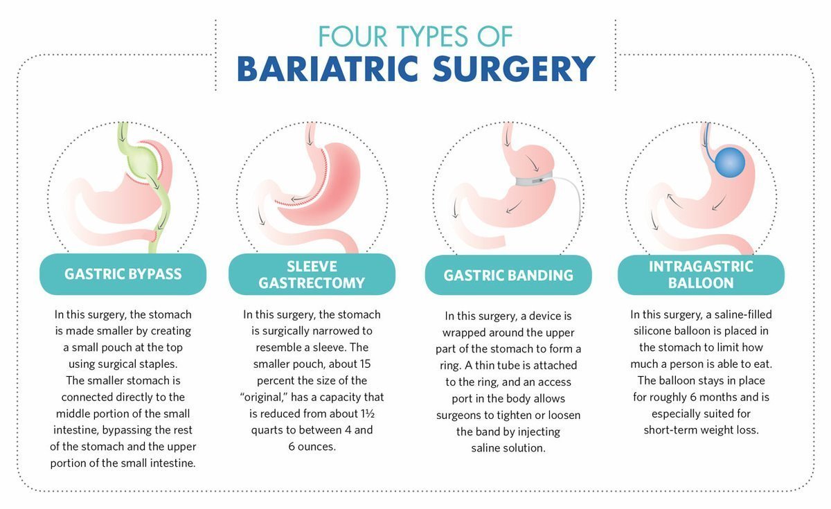 Four Types of bariatric surgery