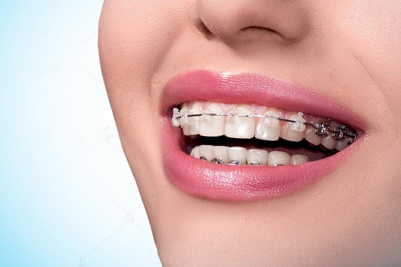 6 Reasons Why Invisalign Is The Best Option For Teens