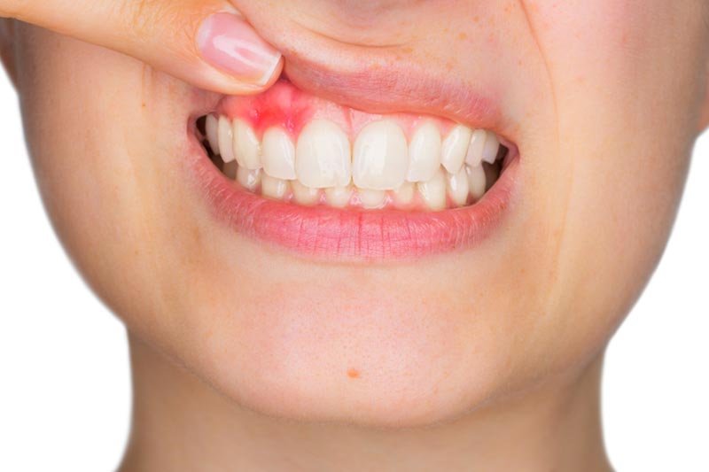 Can Gingivitis Kill You? How Poor Oral Hygiene Can Affect Your Overall Health