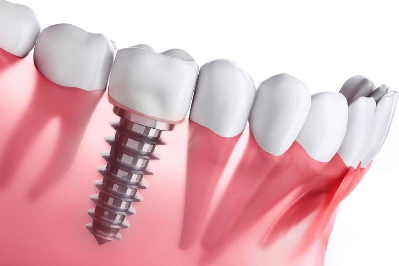 Dental Implant Procedure Explained in 3 Simple Steps
