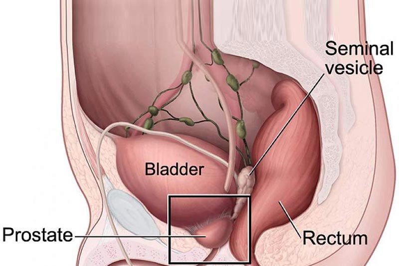 What Causes Prostate Cancer