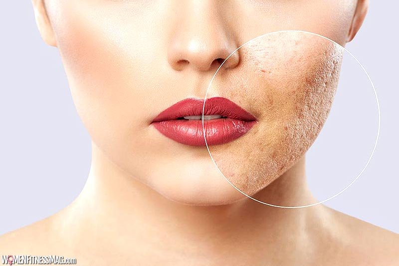 All About Acne Scar Removal in Singapore