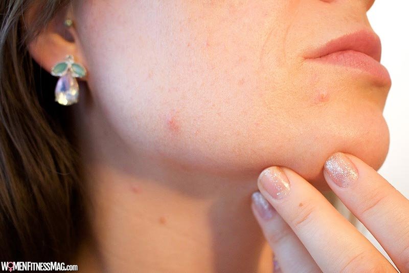 Surprising Benefits Of Using Pimple Patches For Your Skin