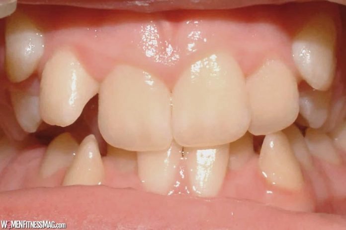 The-Causes-Symptoms-and-Tre The Causes, Symptoms and Treatment of Crowded Teeth
