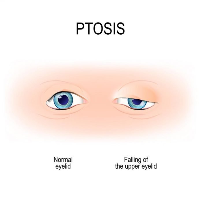 10 Things to Know About Droopy Eyelid Surgery in Singapore