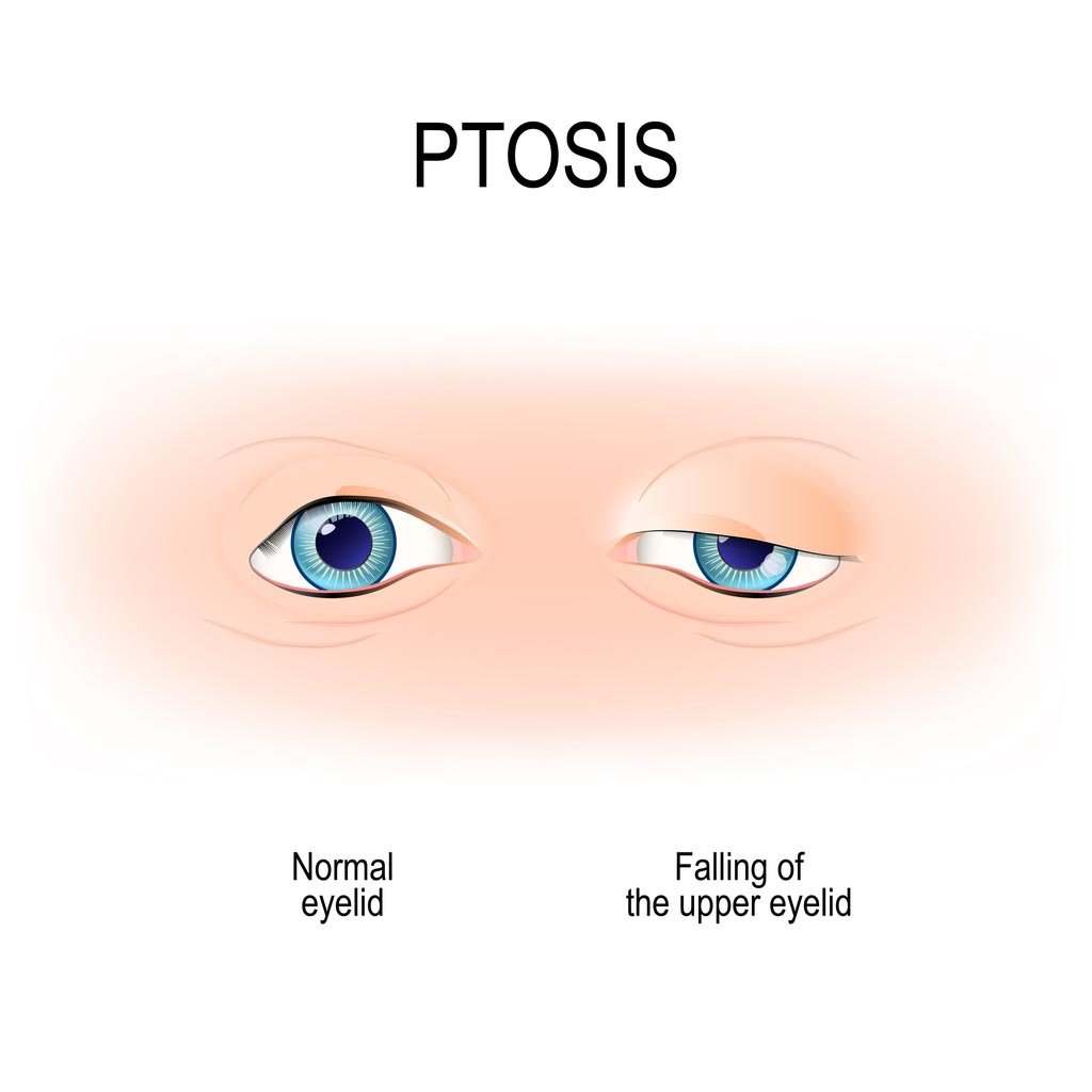 droopy eyelid surgery cost