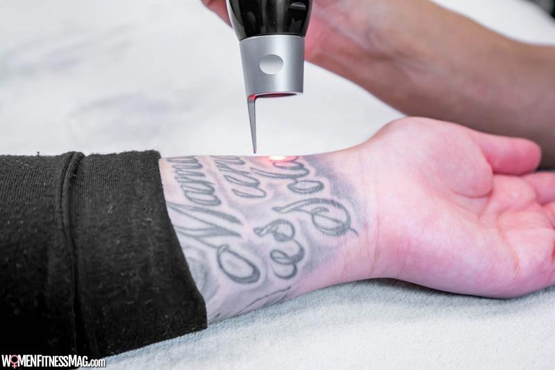 Pico lasers and tattoo removal