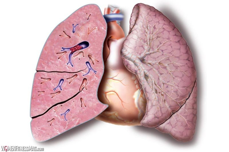 Travel Safely with Pulmonary Embolism