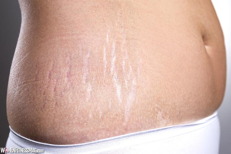 Treating Stretch Marks: The Best Professional Options