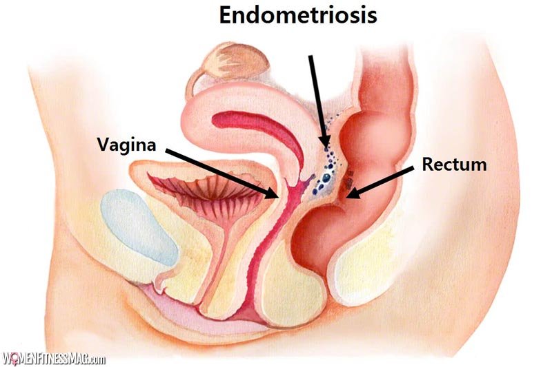 What is endometriosis? How does it affect fertility?
