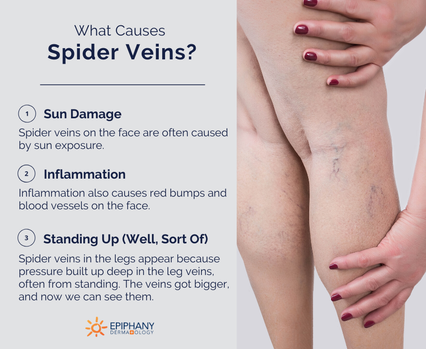 what causes spider veins