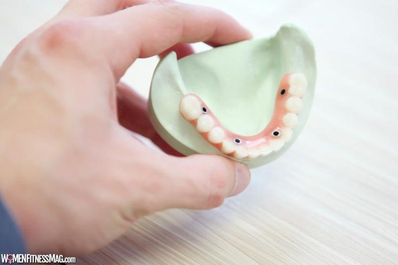 3 Key Reasons to Consider Getting Dental Implants