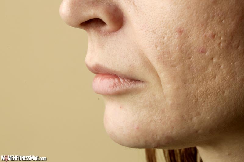 Dermatologist-Approved Treatments For Acne Scars
