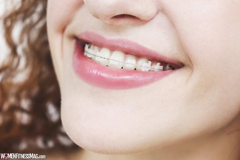 Here's How Getting Braces Won't Affect Your Modelling Career