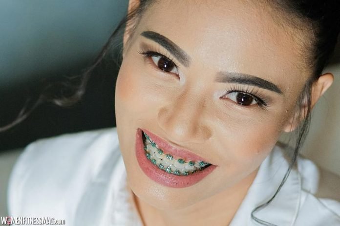 How To Know If You Need Braces - Women Fitness Magazine