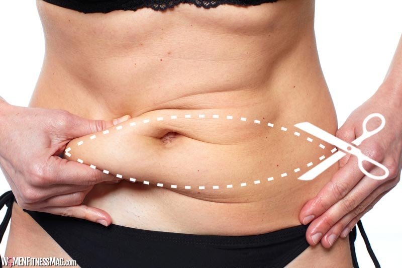 A Tummy Tuck Zaps Away Stubborn Belly Fat