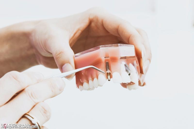 What Is A Dental Implant And How Much Does This Procedure Cost?