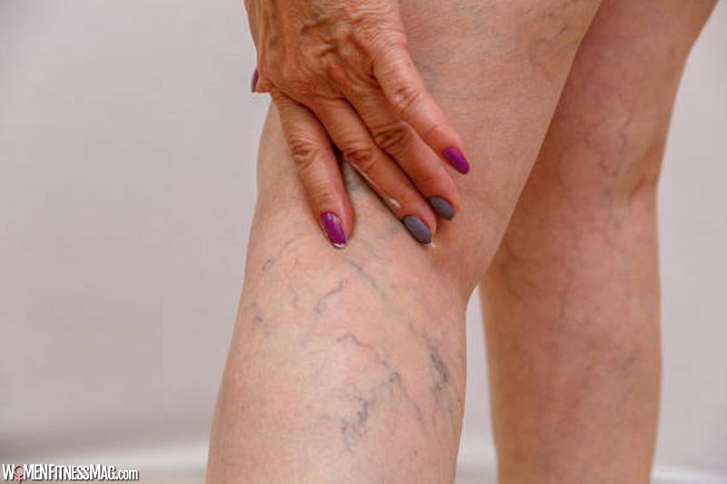 Home Remedies That Can Elevate Varicose Veins